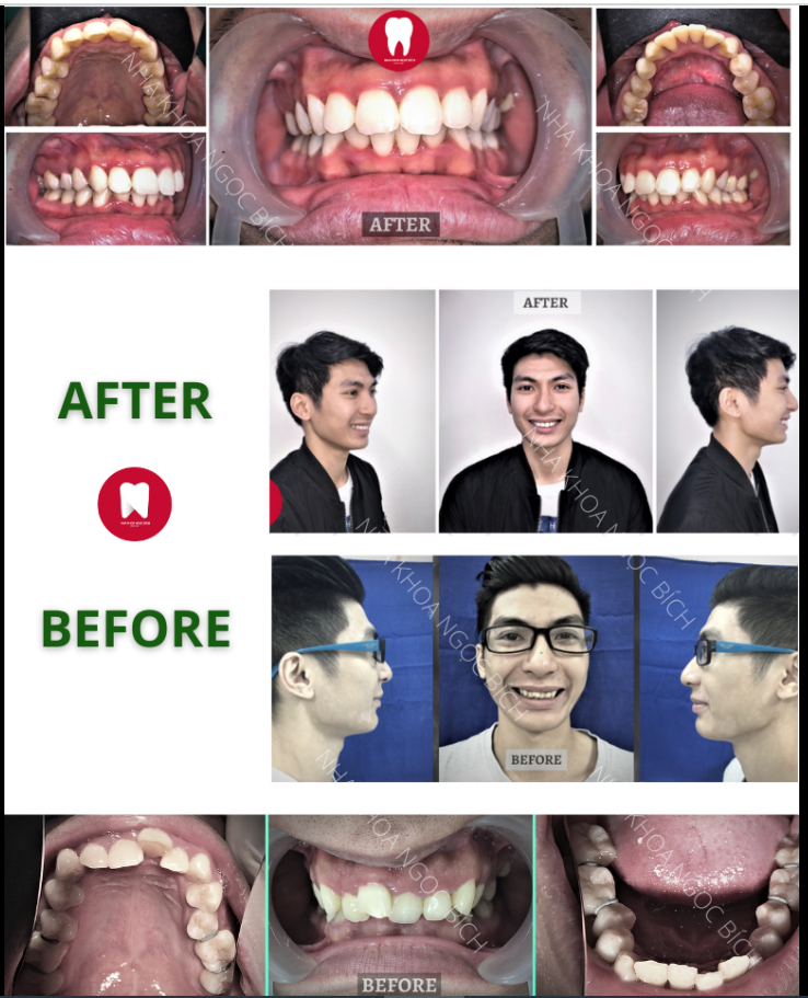 RĂNG ĐỀU ĐẸP - KHỚP CẮN CHUẨN SAU NIỀNG RĂNG TẠI NHA KHOA NGỌC NGỌC BÍCH