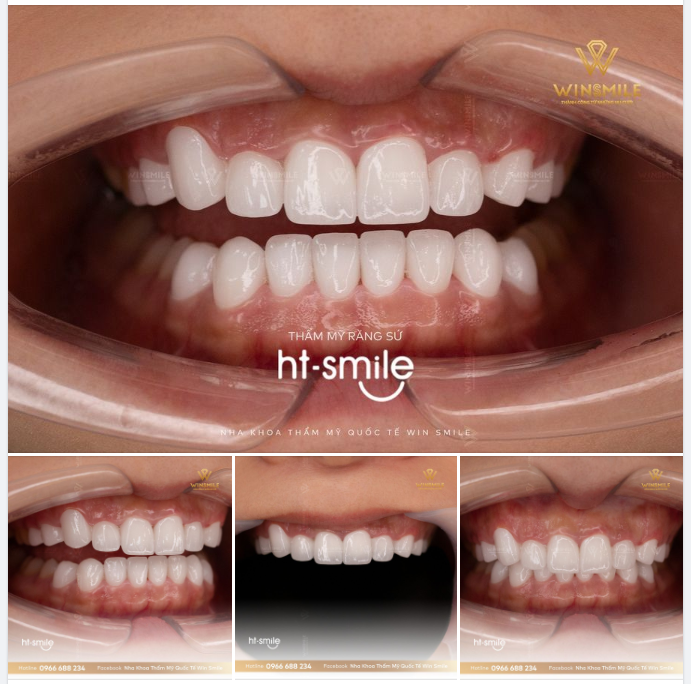 RĂNG DUYÊN DÁNG, TỎA SÁNG CÙNG HT SMILE