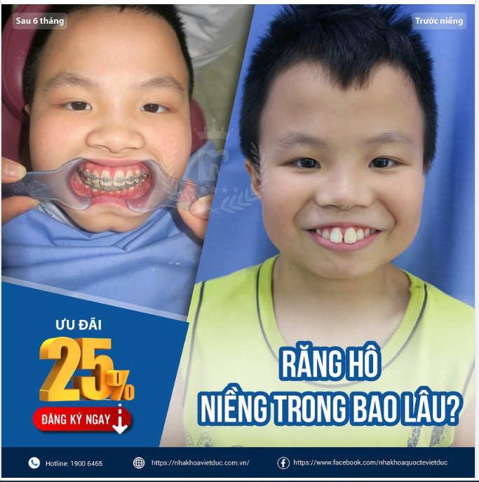 RĂNG HÔ, NIỀNG TRONG BAO LÂU?