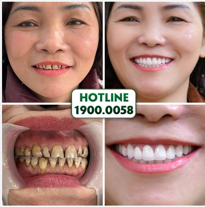 RĂNG KHIẾM KHUYẾT HÓA ĐỀU ĐẸP, TRẮNG SÁNG CHỈ SAU 2 LẦN HẸN