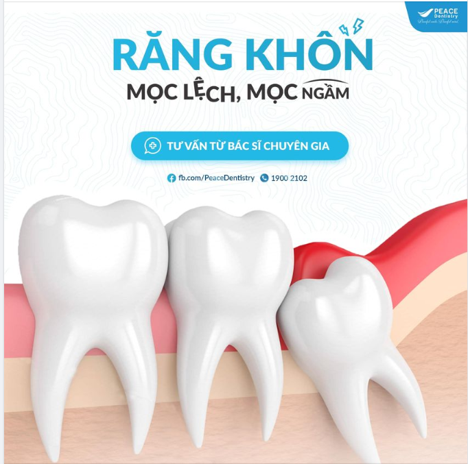 RĂNG KHÔN MỌC LỆCH, MỌC NGẦM 