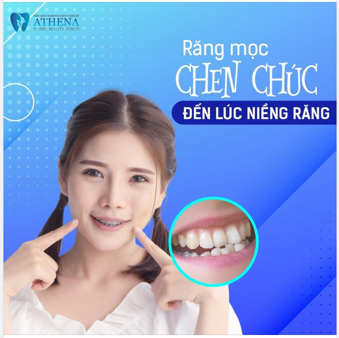 RĂNG MỌC CHEN CHÚC - ĐẾN LÚC NIỀNG RĂNG