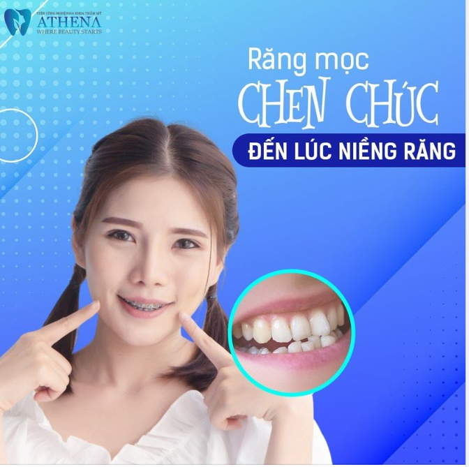 RĂNG MỌC CHEN CHÚC - ĐẾN LÚC NIỀNG RĂNG