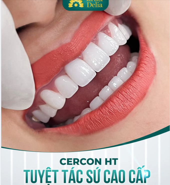 Răng sứ Cercon HT - Răng sứ cao cấp, an toàn được bác sĩ khuyên dùng