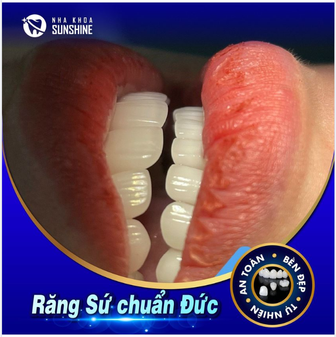RĂNG SỨ CHUẨN ĐỨC – SỰ LỰA CHỌN HOÀN HẢO CHO RĂNG KHUYẾT ĐIỂM