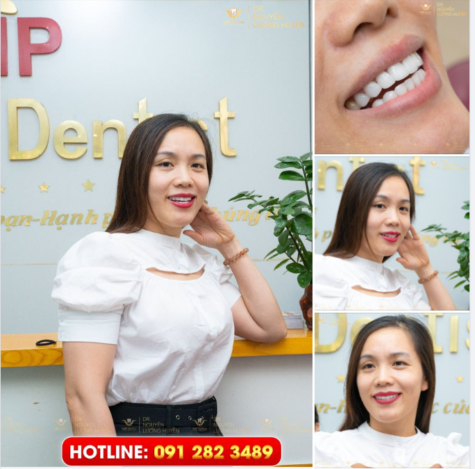 RĂNG SỨ HT SMILE - THAY THẾ MỌI KHUYẾT ĐIỂM, ĐÓN CHÀO NỤ CƯỜI MỚI ĐẸP KHÔNG TÌ VẾT
