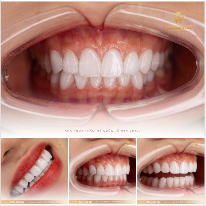 RĂNG SỨ VẪN HOÀN HẢO SAU 3 NĂM ĐỒNG HÀNH - VẺ ĐẸP ĐI CÙNG VỚI SỰ BỀN VỮNG