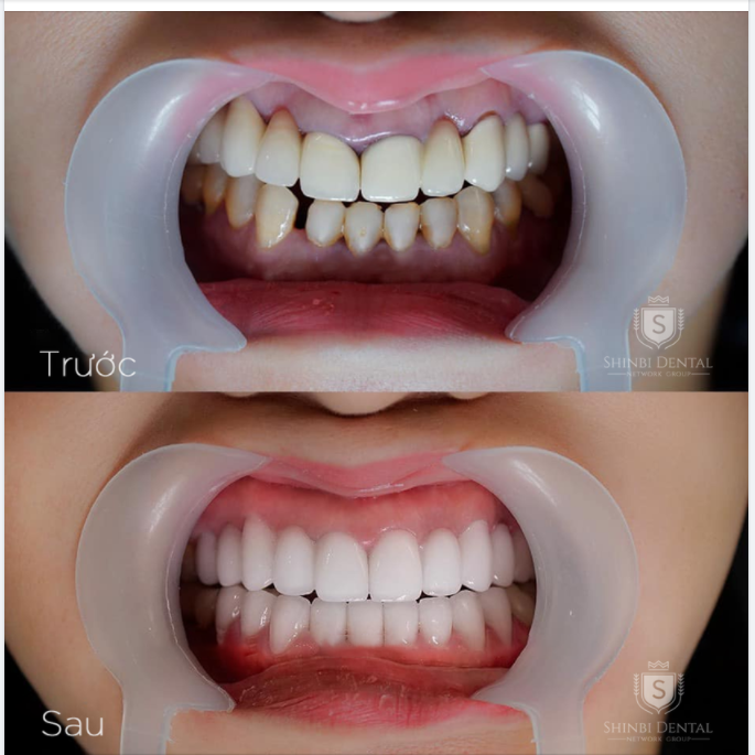 RĂNG THƯA HỞ KẼ - CƯỜI KHẼ CŨNG KHÔNG TỰ TIN