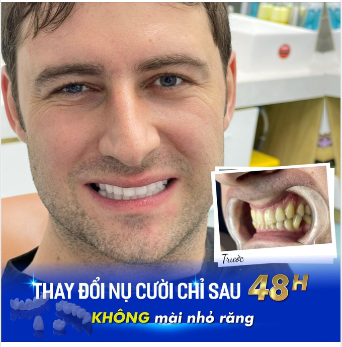 RĂNG TRẮNG SÁNG ĐỀU ĐẸP – KHÔNG MÀI NHỎ RĂNG