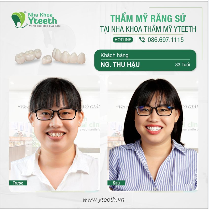 RĂNG TƯƠI XINH TRẮNG SÁNG - RẠNG RỠ ĐÓN NẮNG HÈ