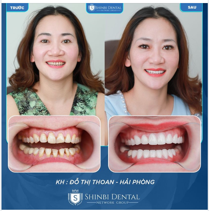 RŨ BỎ LỚP "ÁO VÀNG" XỈN MÀU BẰNG CHIẾC "ÁO MỚI" TRẮNG TINH KHÔI