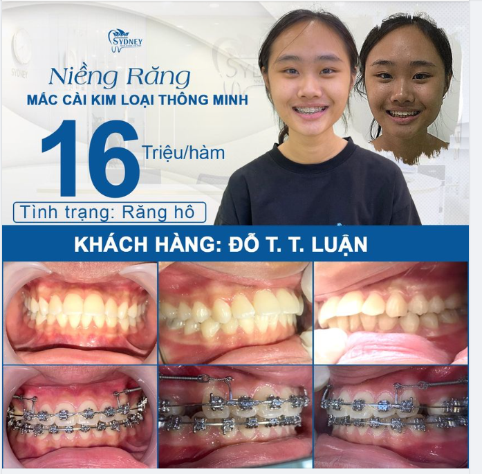 RÚT NGẮN THỜI GIAN ĐEO NIỀNG
