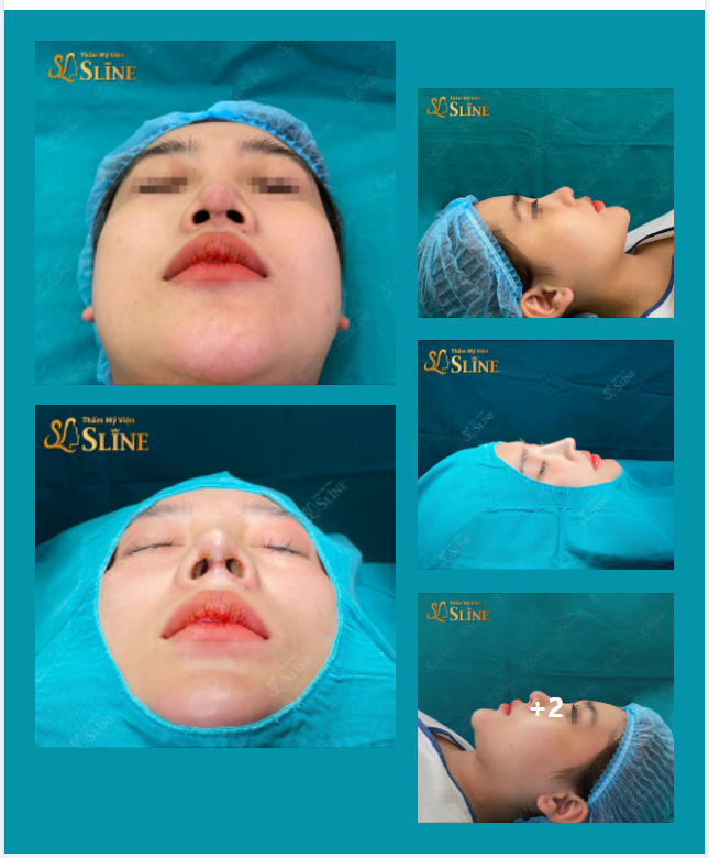 S.O.S GIẢI CỮU MŨI HỎNG