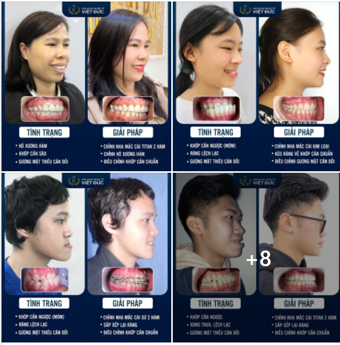 Sai lệch khớp cắn là tình trạng phổ biến hiện nay.