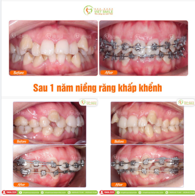 SAU 1 NĂM NIỀNG RĂNG CẢI THIỆN CHEN CHÚC