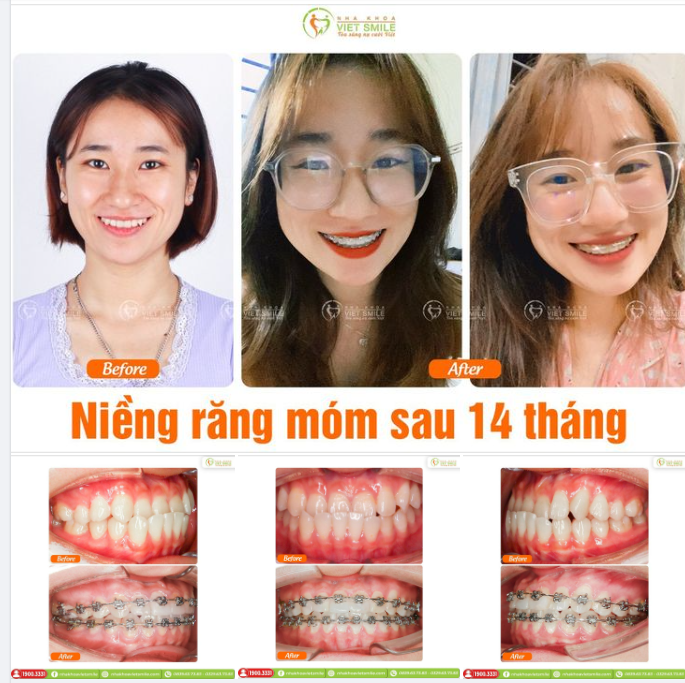 SAU 14 NIỀNG RĂNG MÓM - TRẺ HƠN, TỰ TIN HƠN