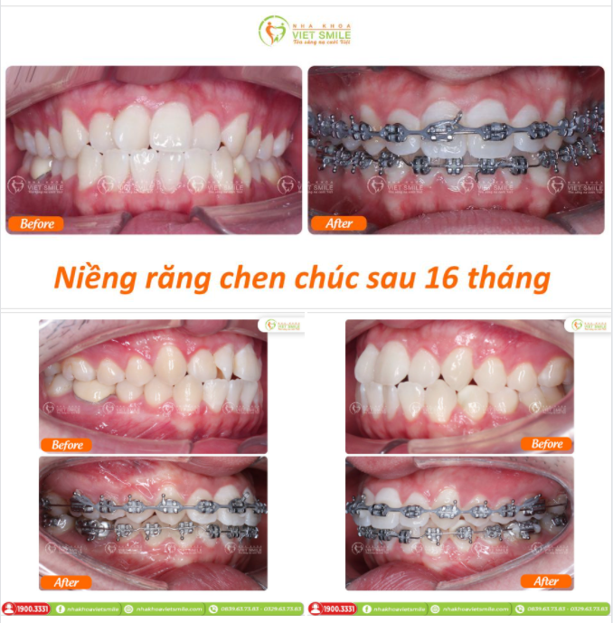 SAU 16 THÁNG NIỀNG RĂNG CẢI THIỆN CHEN CHÚC