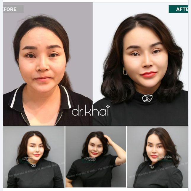 SAU 6 THÁNG CĂNG DA MIDFACE + NÂNG KHUNG CHÂN MÀY NỘI SOI, KHÁCH HÀNG ĐƯỢC GÌ