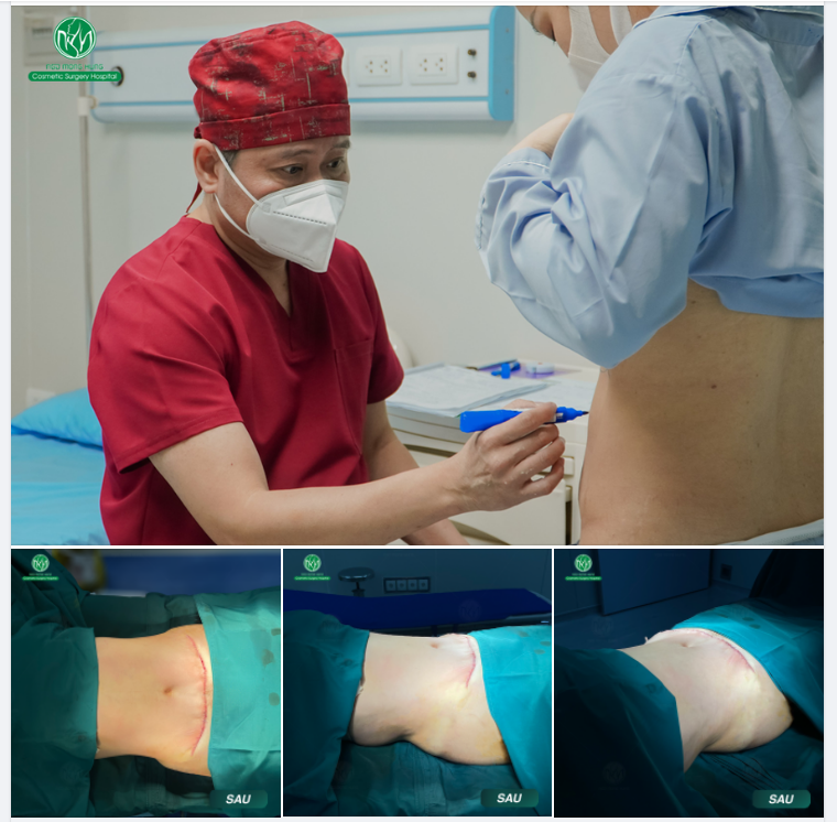 SAU SINH EO NGẤN MỠ XEM CÁCH KHẮC PHỤC BÊN DƯỚI!!