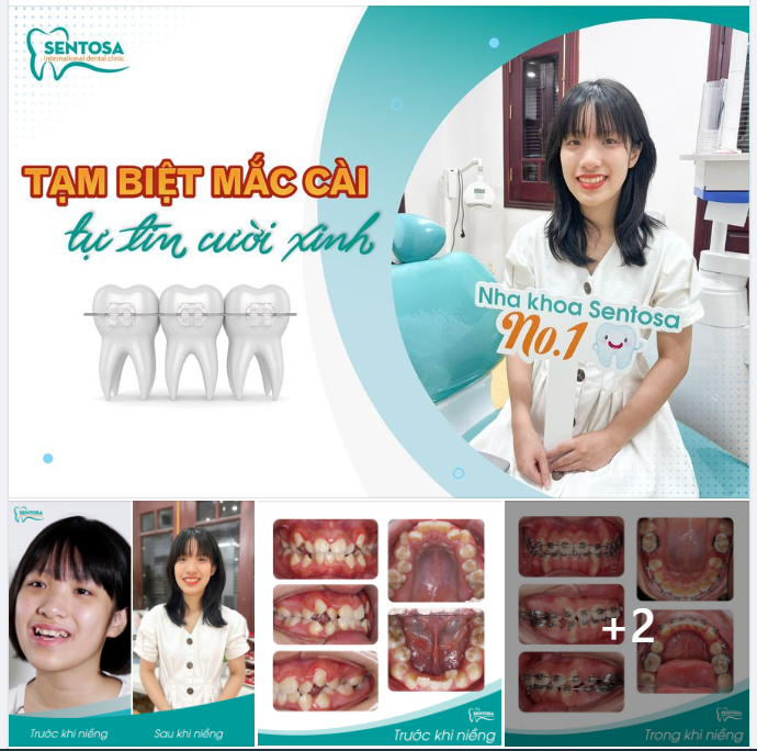 "SAY BYE" MẮC CÀI, TỰ TIN CƯỜI XINH