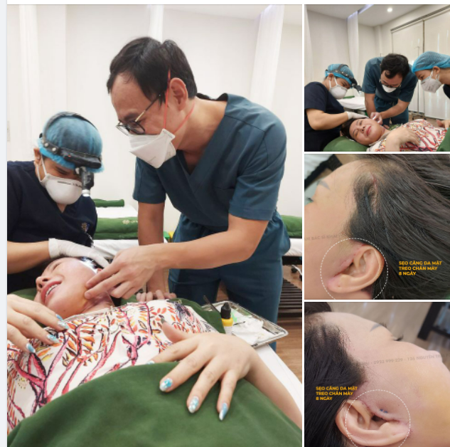 SẸO CĂNG DA MẶT VÀ NÂNG KHUNG CHÂN MÀY BAO GIỜ LÀNH