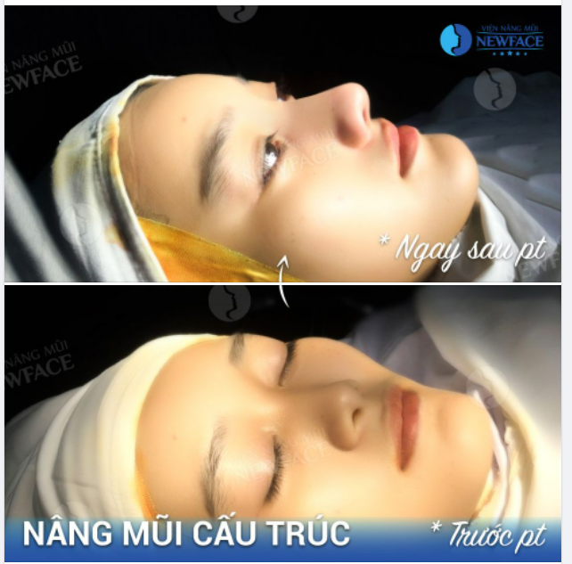 “SIÊU PHẨM” NÂNG MŨI CẤU TRÚC SURGIFORM CẢ NHÀ ƠI!