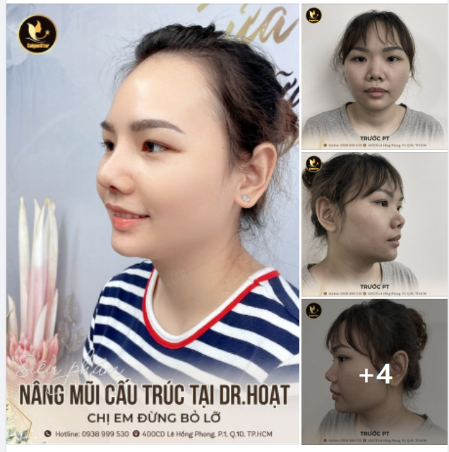 SIÊU PHẨM NÂNG MŨI CẤU TRÚC TẠI DR.HOẠT - CHỊ EM ĐỪNG BỎ LỠ