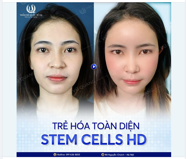 Siêu trẻ hóa Stem Cells HD- Mặt đẹp dáng thon chỉ với 25tr- tặng 11tr