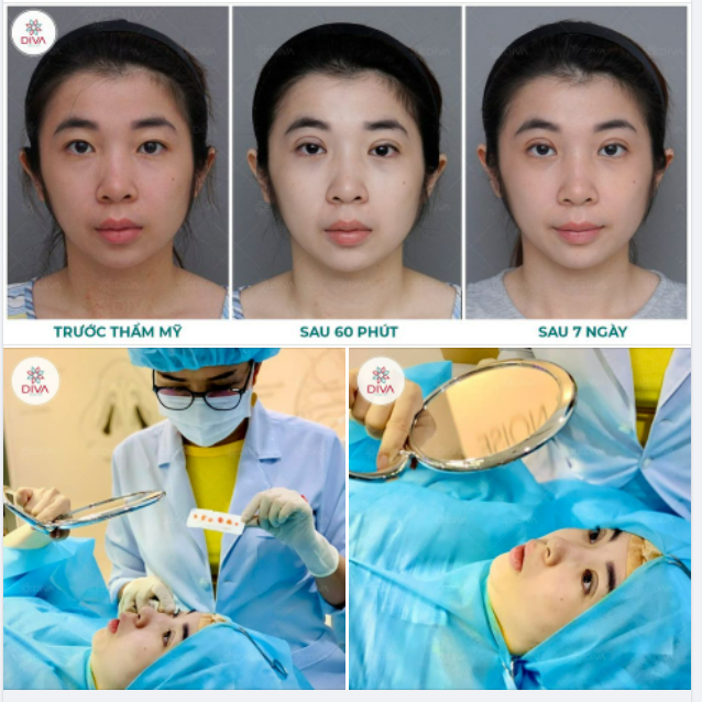 SỞ HỮU MẮT 2 MÍ TỰ NHIÊN SAU NHẤN MÍ