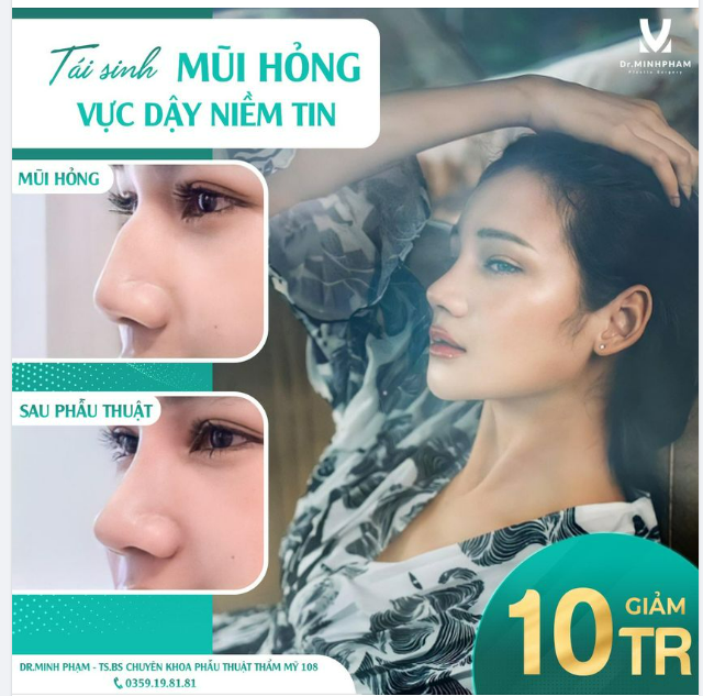 Sở hữu một dáng mũi thon gọn, thanh tú là mơ ước của mọi khách hàng song không phải ai cũng “chỉnh sửa” mũi thành công.