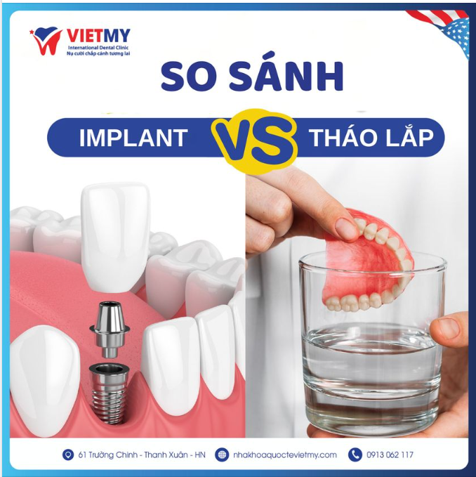 So sánh trồng răng Implant và hàm giả tháo lắp