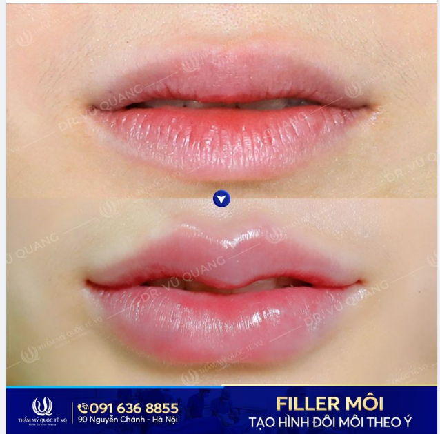 Song hành cùng chương trình Tái sinh mũi hỏng - Vực dậy niềm tin - Thẩm mỹ quốc tế VQ còn có Series những đôi môi xinh với dịch vụ Tiêm Filler môi