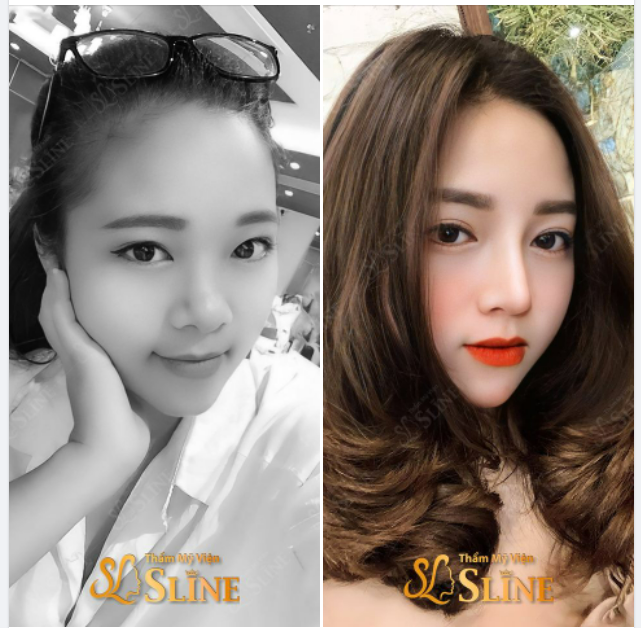 SỰ KHÁC BIỆT  Với dáng mũi cấu trúc được thực hiện bởi bác sĩ ekip Sline.