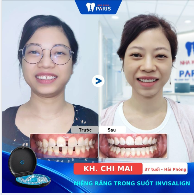 SỰ THAY ĐỔI NGOẠN MỤC SAU NIỀNG RĂNG Ở ĐỘ TUỔI 37!