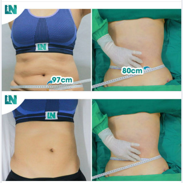 SỰ THAY ĐỔI SAU 2 GIỜ HÚT MỠ BỤNG NHƯ THẾ NÀO