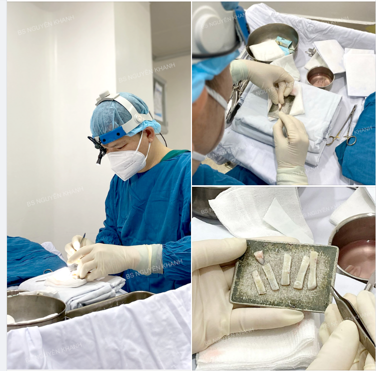 SỤN SƯỜN HAY SỤN TAI SẼ TỐT HƠN CHO PHẪU THUẬT NÂNG MŨI CẤU TRÚC
