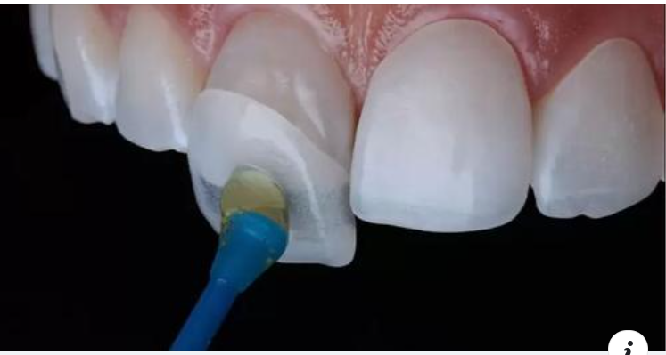Tác hại của bọc răng sứ bị lệch khớp cắn và cách chữa trị hiệu quả