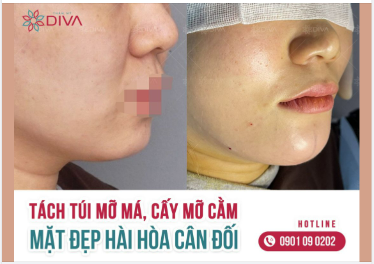 TÁCH TÚI MỠ MÁ, CẤY MỠ COLEMAN CẰM MẶT ĐẸP HÀI HÒA CÂN ĐỐI