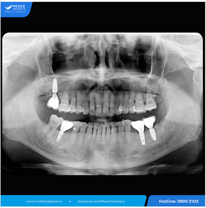 TÁI KHÁM ĐỊNH KỲ - BÍ QUYẾT BẢO VỆ RĂNG IMPLANT CHẮC KHỎE ỔN ĐỊNH LÂU DÀI