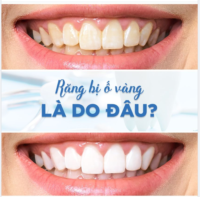 Tại sao đánh răng thường xuyên mà răng vẫn bị ố vàng?
