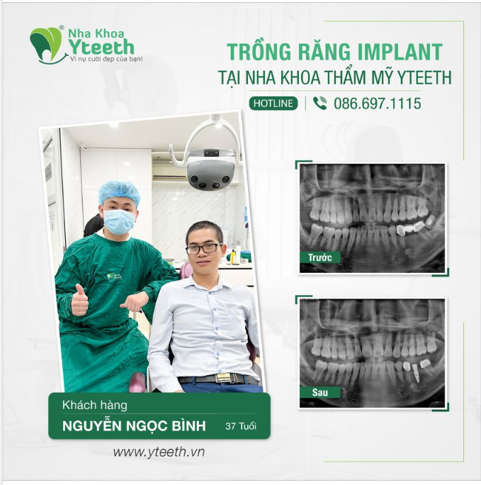 Tại sao nên lựa chọn cấy ghép Implant