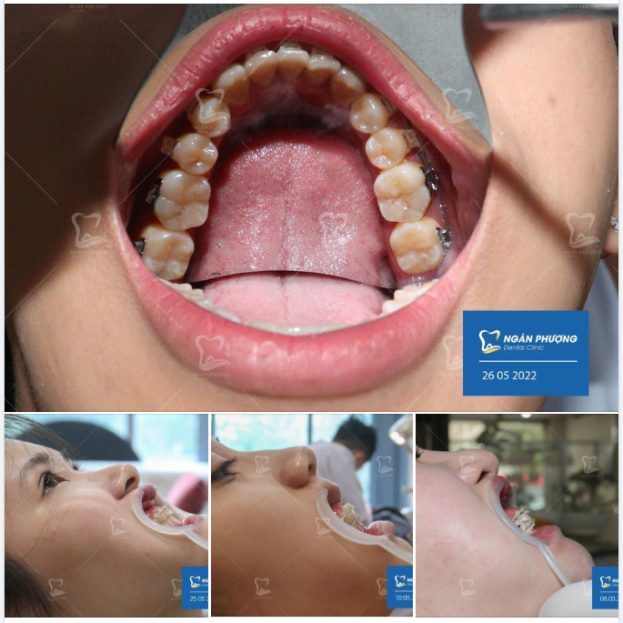 TẠI SAO TÁI KHÁM ĐỊNH KỲ TRONG KHI CHỈNH NHA LẠI QUAN TRỌNG