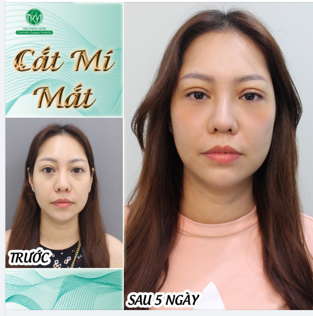 TÁI TẠO NẾP MÍ MỚI ĐỀU ĐẸP 2 BÊN VỚI PHƯƠNG PHÁP CẮT MÍ MẮT