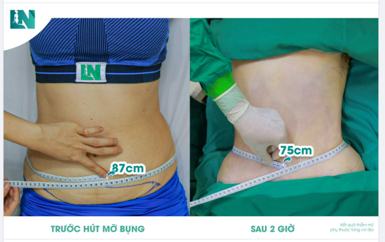 TẠM BIỆT 12CM NGẤN MỠ, BỤNG SỒ SỀ HÓA THẮT ĐÁY GỌN THON!