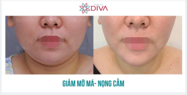 TẠM BIỆT MẶT NỌNG, MỠ MẶT DÀY SỞ HỮU MẶT VLINE THANH THOÁT SAU THẨM MỸ