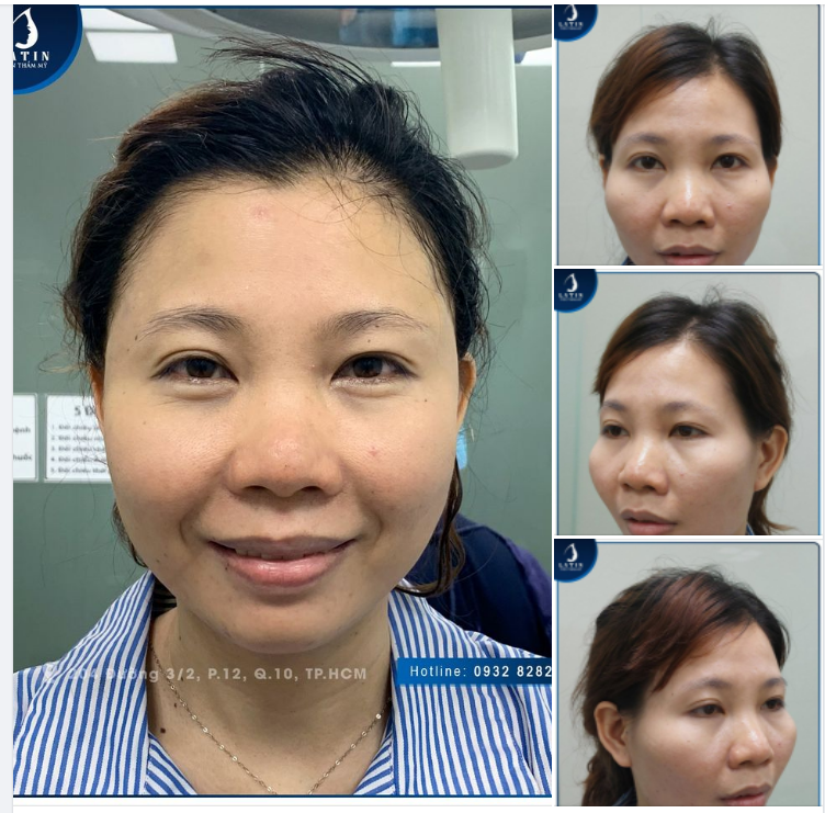 Tạm biệt thái dương hóp, chào đón gương mặt trẻ xinh