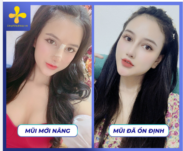 TAN BẦM, TIÊU VIÊM SAU NÂNG MŨI CHỈ LÀ CHUYỆN NHỎ NẾU BẠN BIẾT MẸO NÀY!