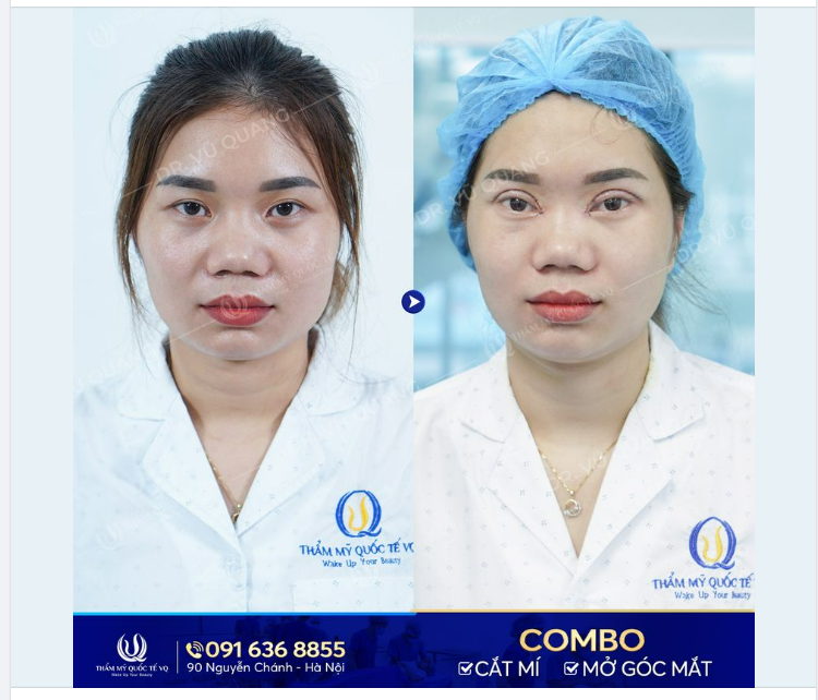 Tân trang cửa sổ tâm hồn cho KH đến từ Hà Tĩnh