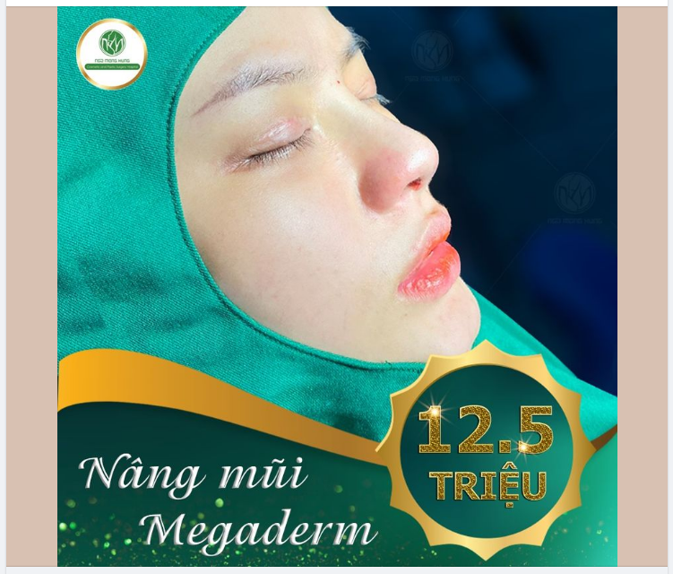 TẶNG 10SUẤT NÂNG MŨI MEGADERM CHỈ 12.5 TRIỆU