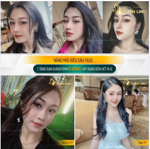 TẶNG NGAY SỤN SURGIFORM 0 ĐỒNG